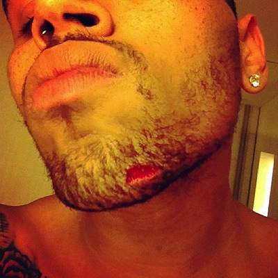 Chris Brown's bloody chin
