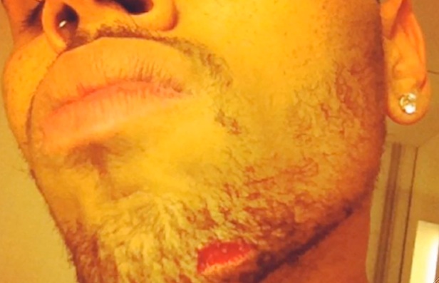 Chris Brown chin