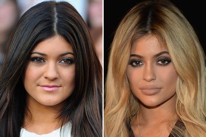 kylie-jenner-lip-injections