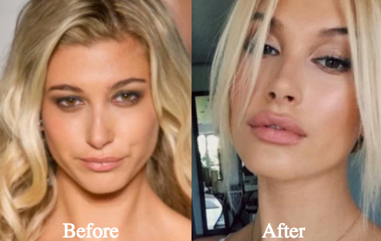 Hailey baldwin plastic surgery before and after photos